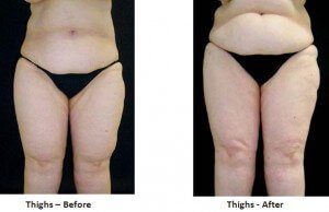 Lipedema Patients Are Turning to Tumescent Liposuction for Relief 