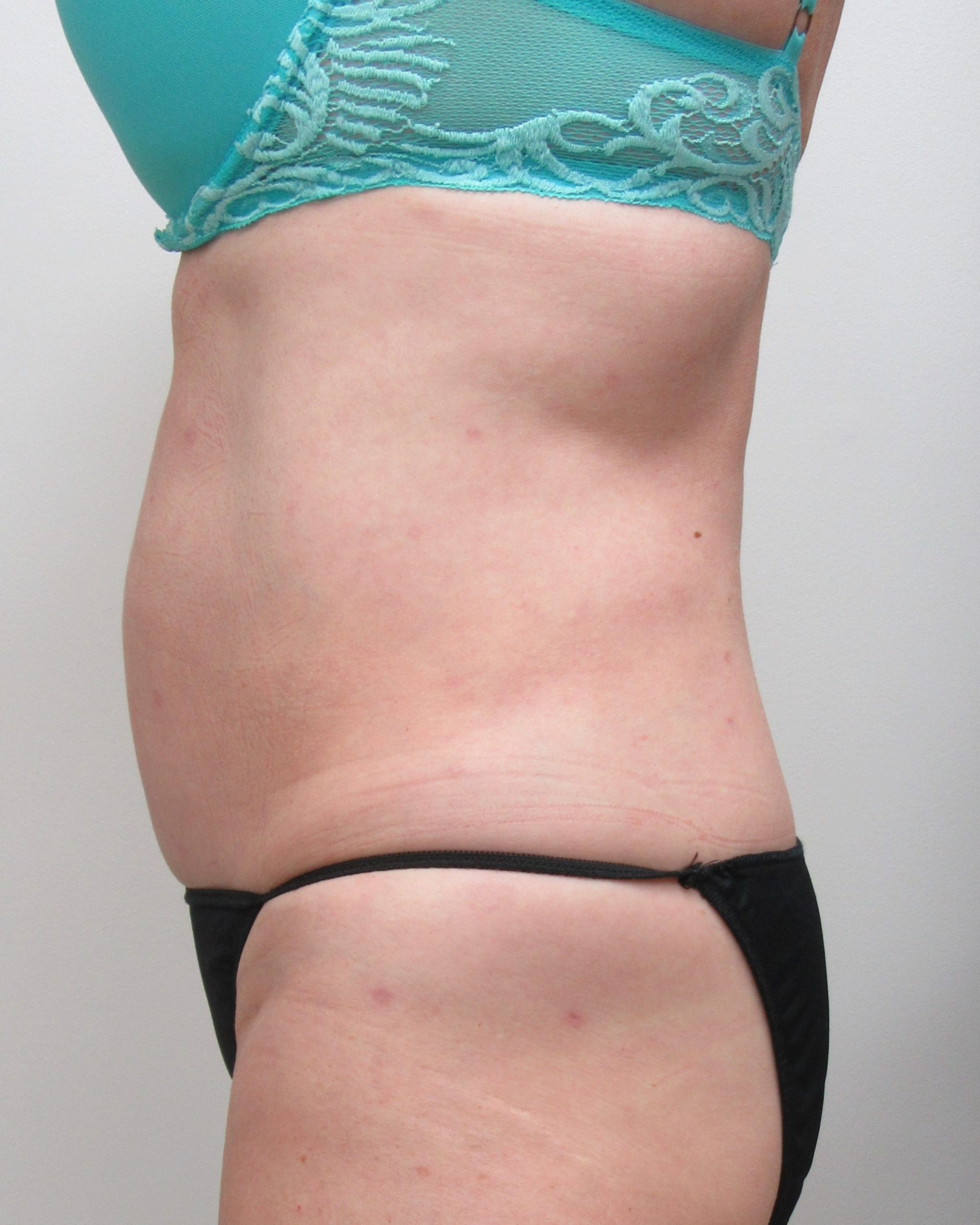 Liposuction Before & After Photos 