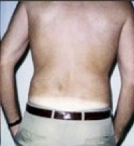 Patient 8284, Flank-Lower Back Liposuction, Male Liposuction Gallery