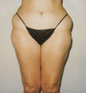 Liposuction Before & After: Abdomen/Waist/Hips/Outer Thighs - Liposuction .com